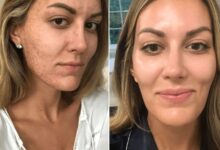 Photo of Transform Your Skin: Micro Needling Before and After