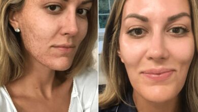 Photo of Transform Your Skin: Micro Needling Before and After